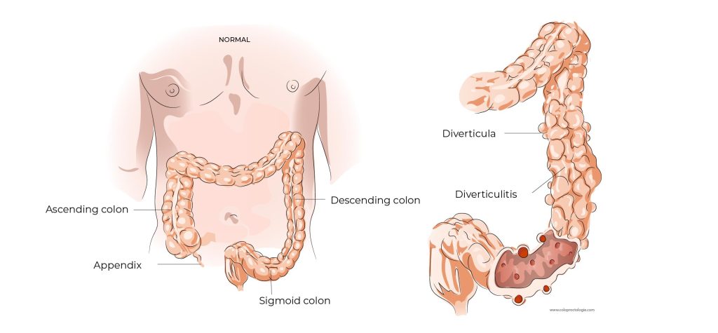 Diverticulitis